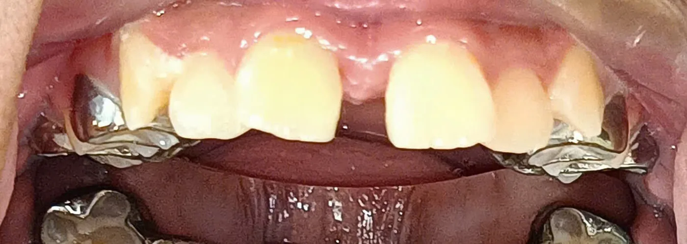 Khe thưa giữa hai răng cửa giữa — dấu hiệu lâm sàng của việc tách đường khớp giữa vòm miệng.