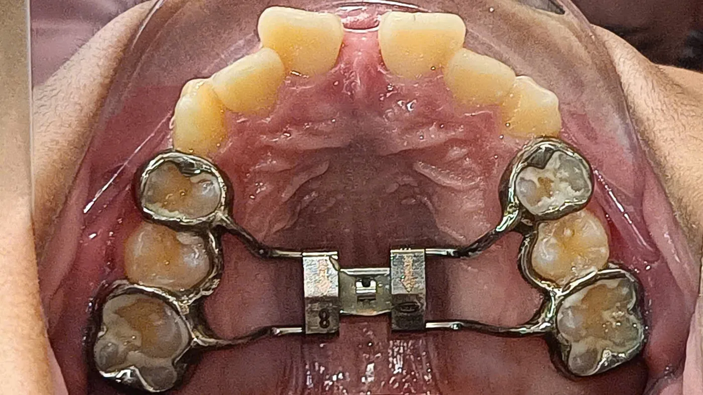 Khí cụ RME với khâu cá nhân hóa, nhìn từ mặt nhai sau khi gắn.