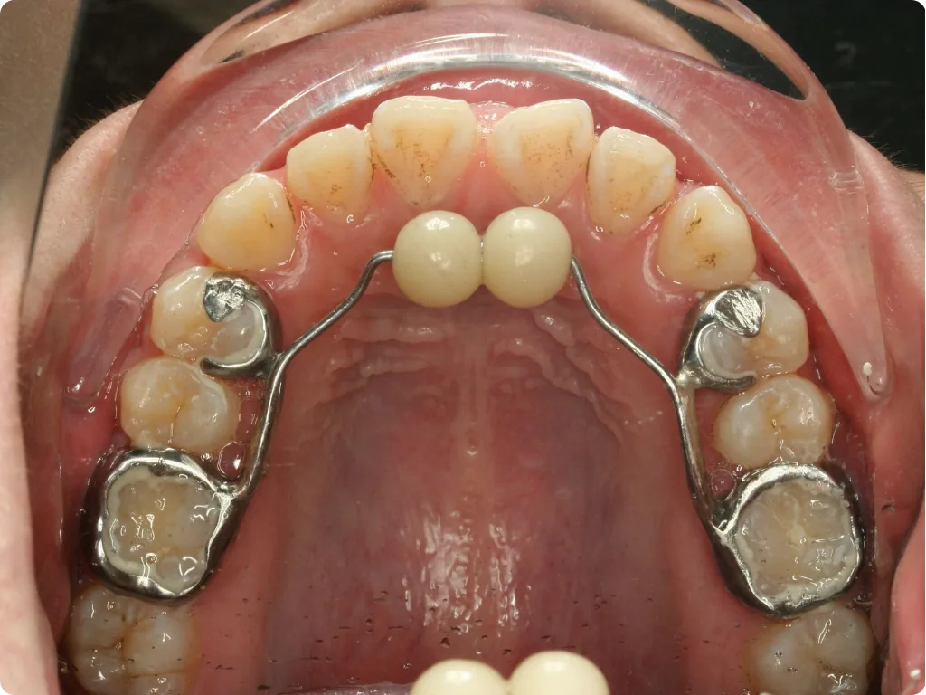 Khí cụ tại chỗ sau một lần hẹn.